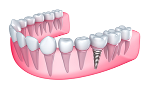 Dental Implants in Wichita, KS